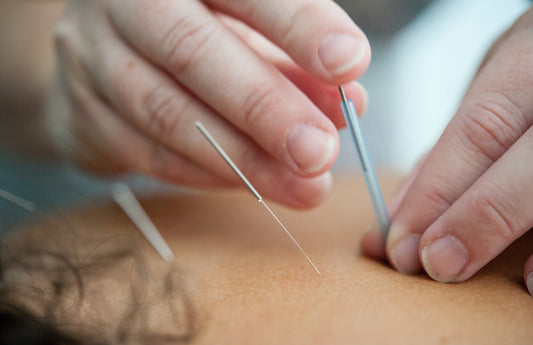 L'acupuncture pour une meilleure santé